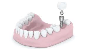 implant-systemic-toxicity-test