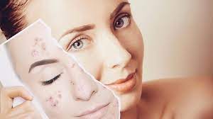 anti-acne-product-testing