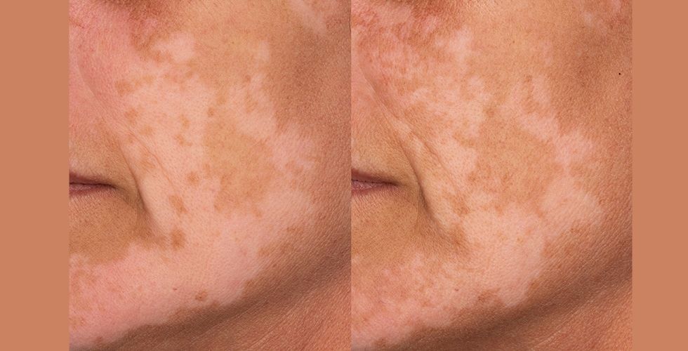 clinical-assessment-of-sunscreens