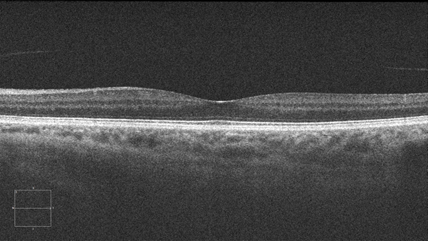 optical-coherence-tomography-oct-for-skin-evaluation