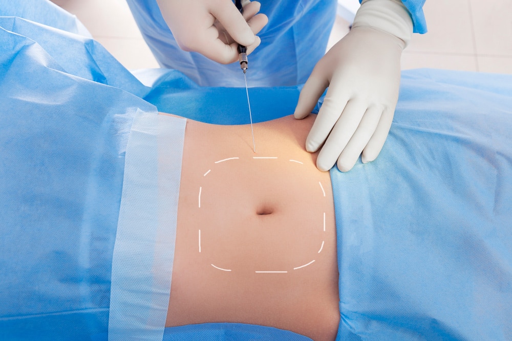fat-removal-techniques