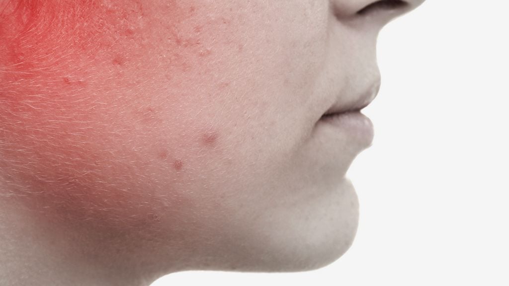 iso-10993-10-evaluation-of-skin-irritation-and-sensitization