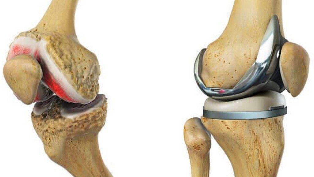 astm-f2183-fatigue-testing-of-knee-implants
