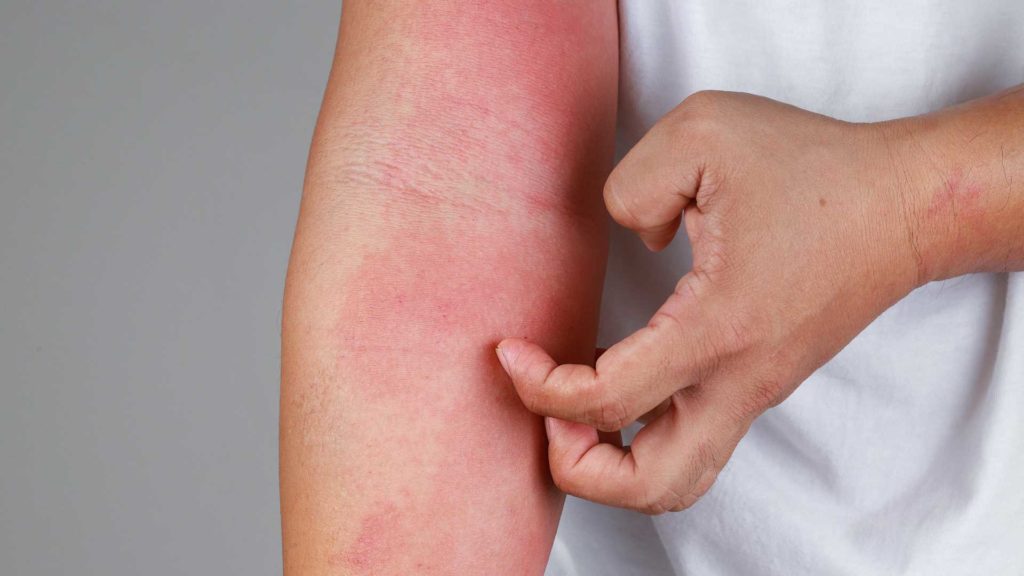 allergic-reactions-sensitivities